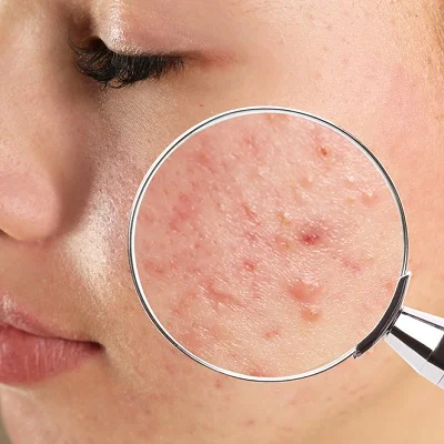 acne skin on a patient