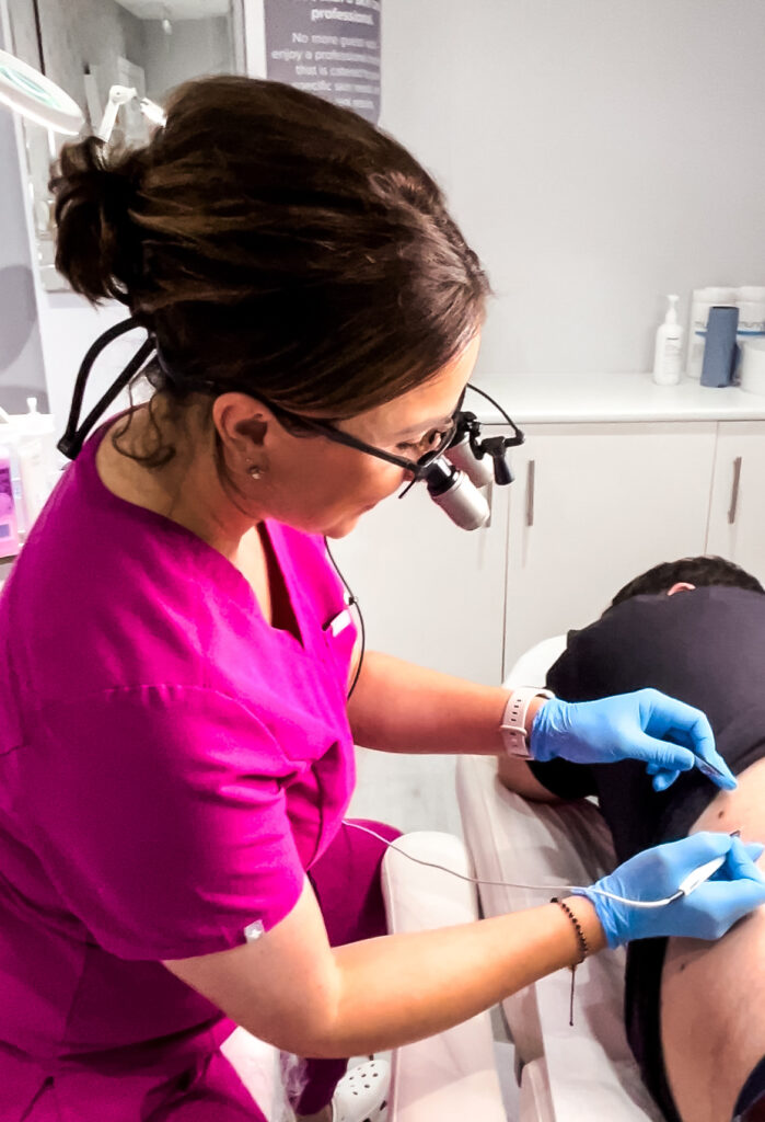 Aesthetician removing skin tag from the back