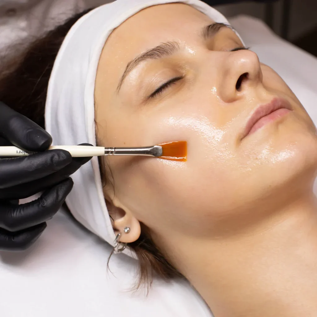 Client having chemical peel applied on her skin. Facial skin treatment