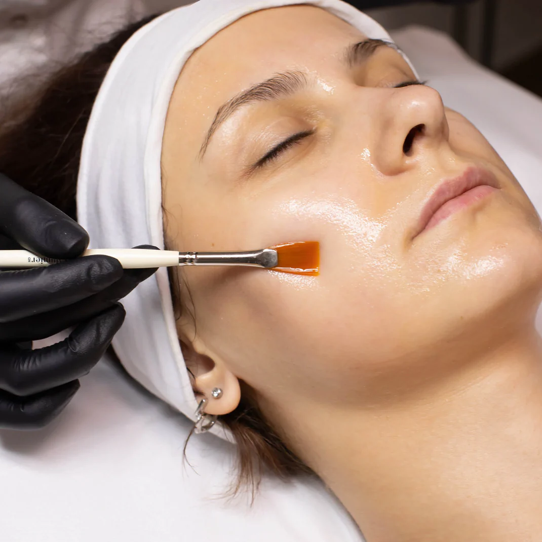 Client having chemical peel applied on her skin. Facial skin treatment