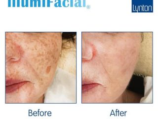 IPL photo rejuveanation IllumiFacial before and after