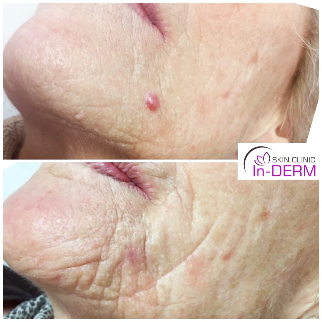 Before and after photos mole removal