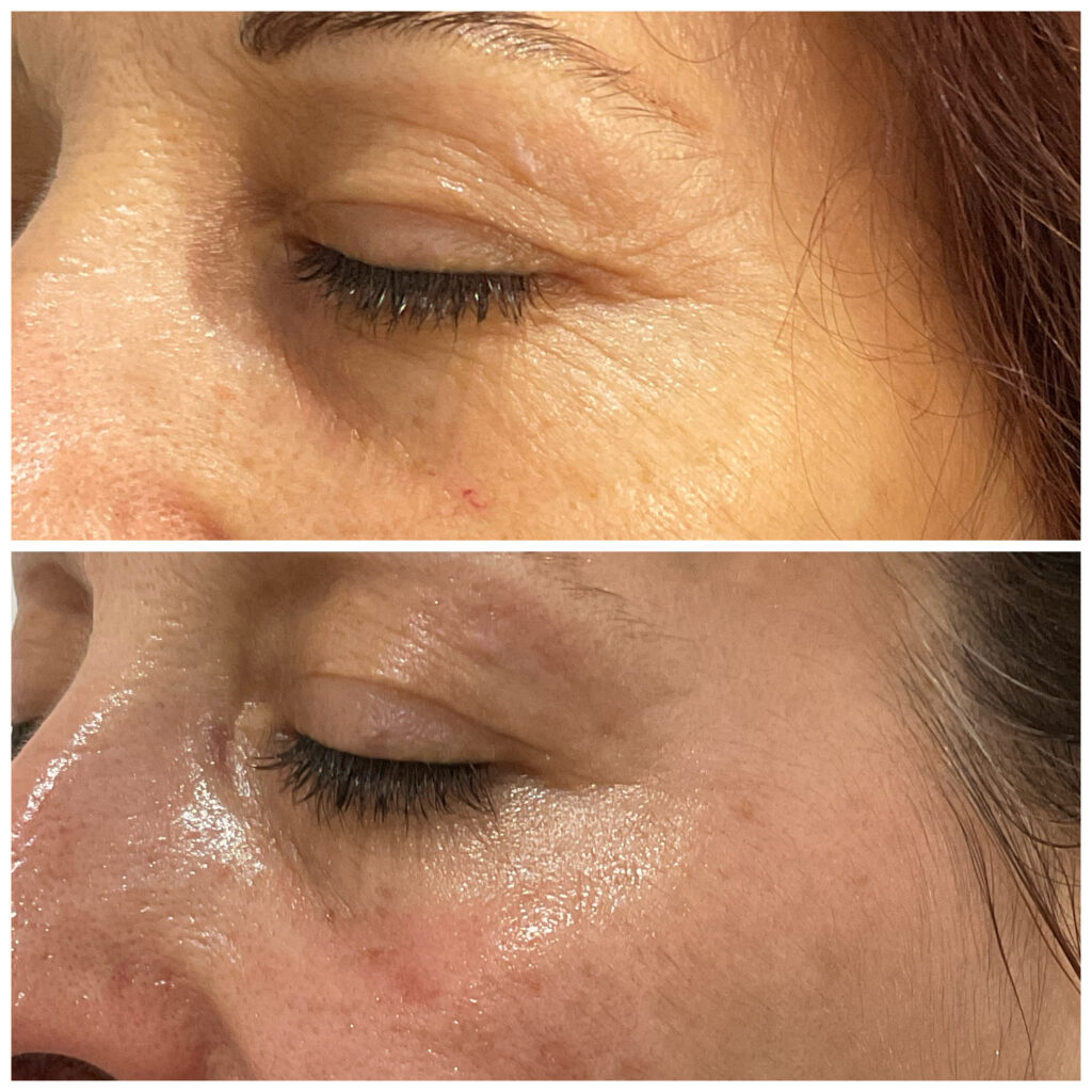 Before and after course of facials