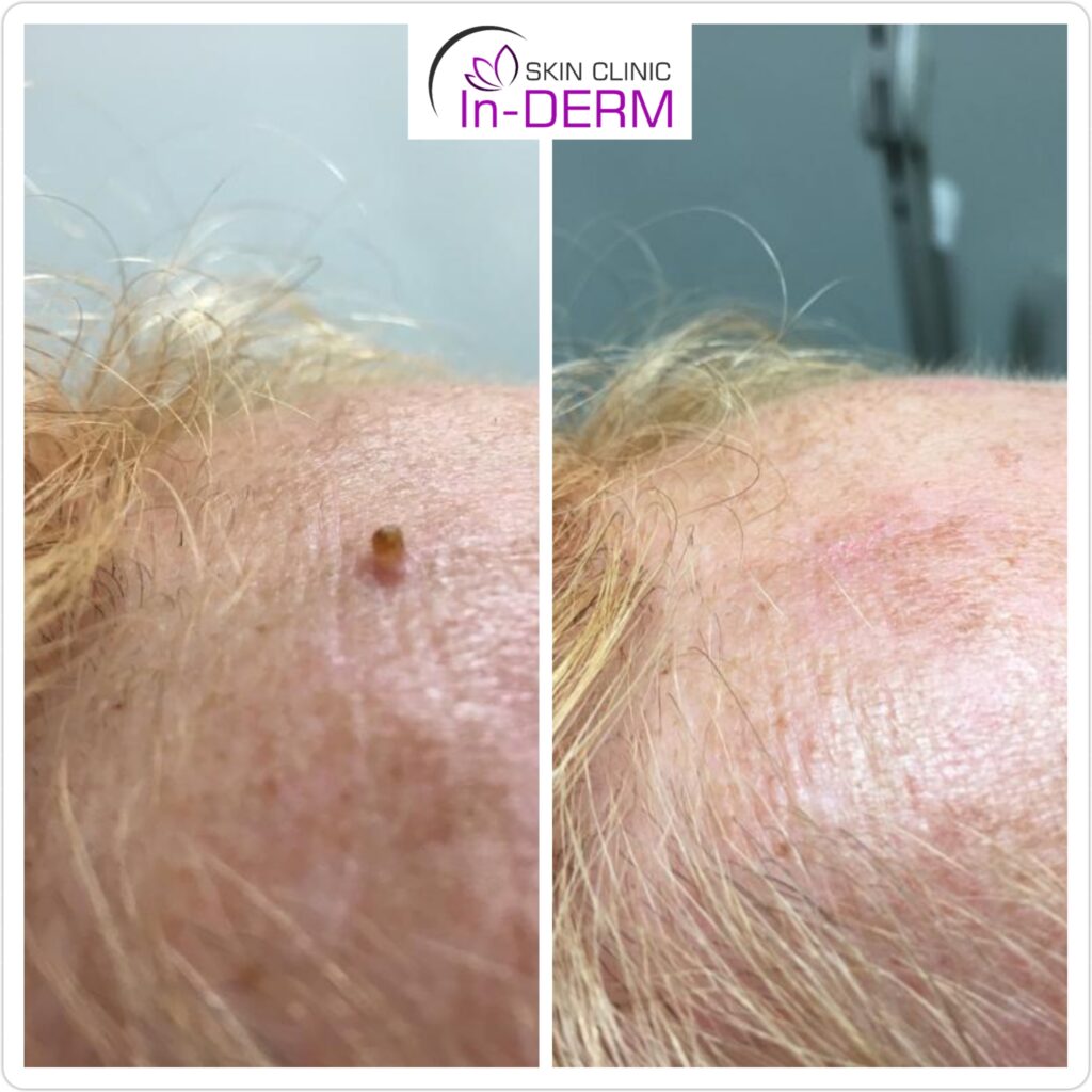 Wart removal before and after on clients forehead