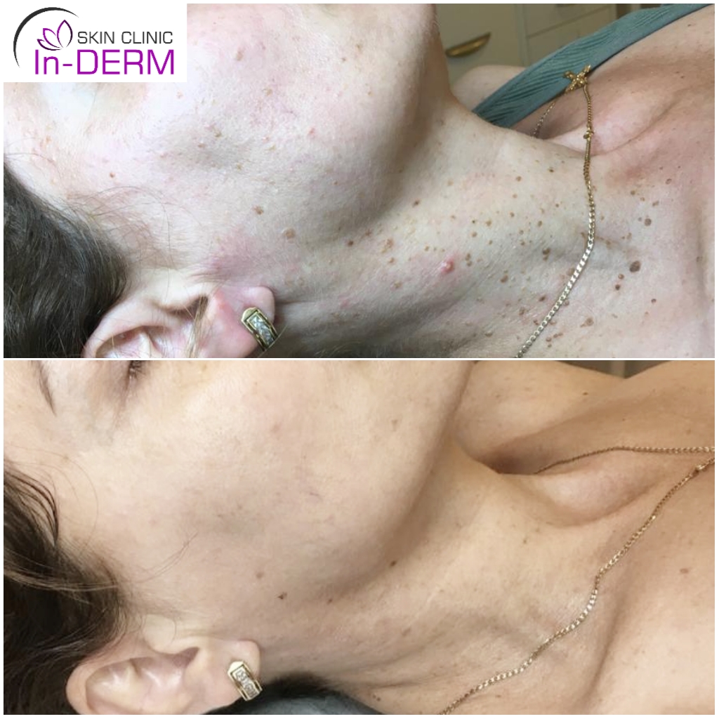 Skin tag removal before and after