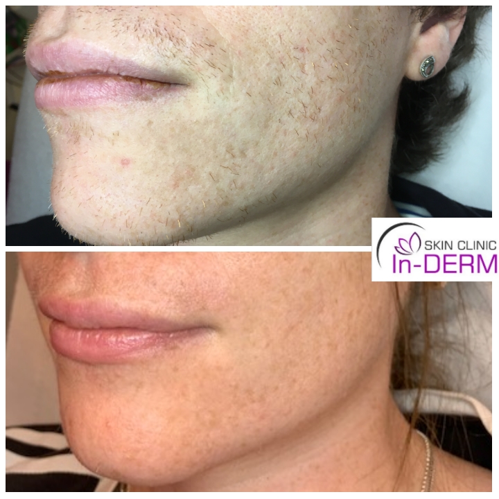 Electrolysis hair removal results before and after the course