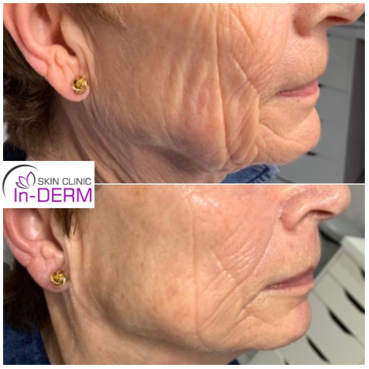RF skin tightening before and after comparison
