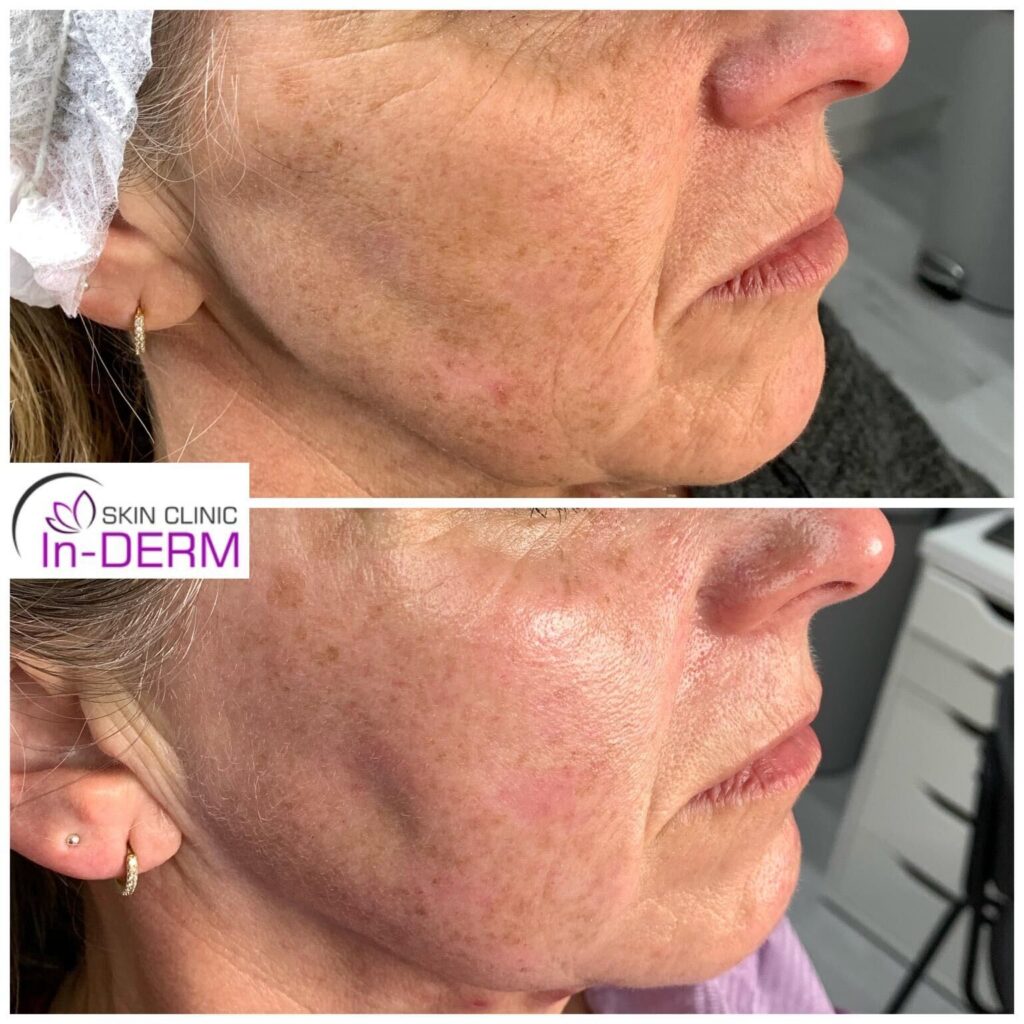 RF Skin Tightening Before & After