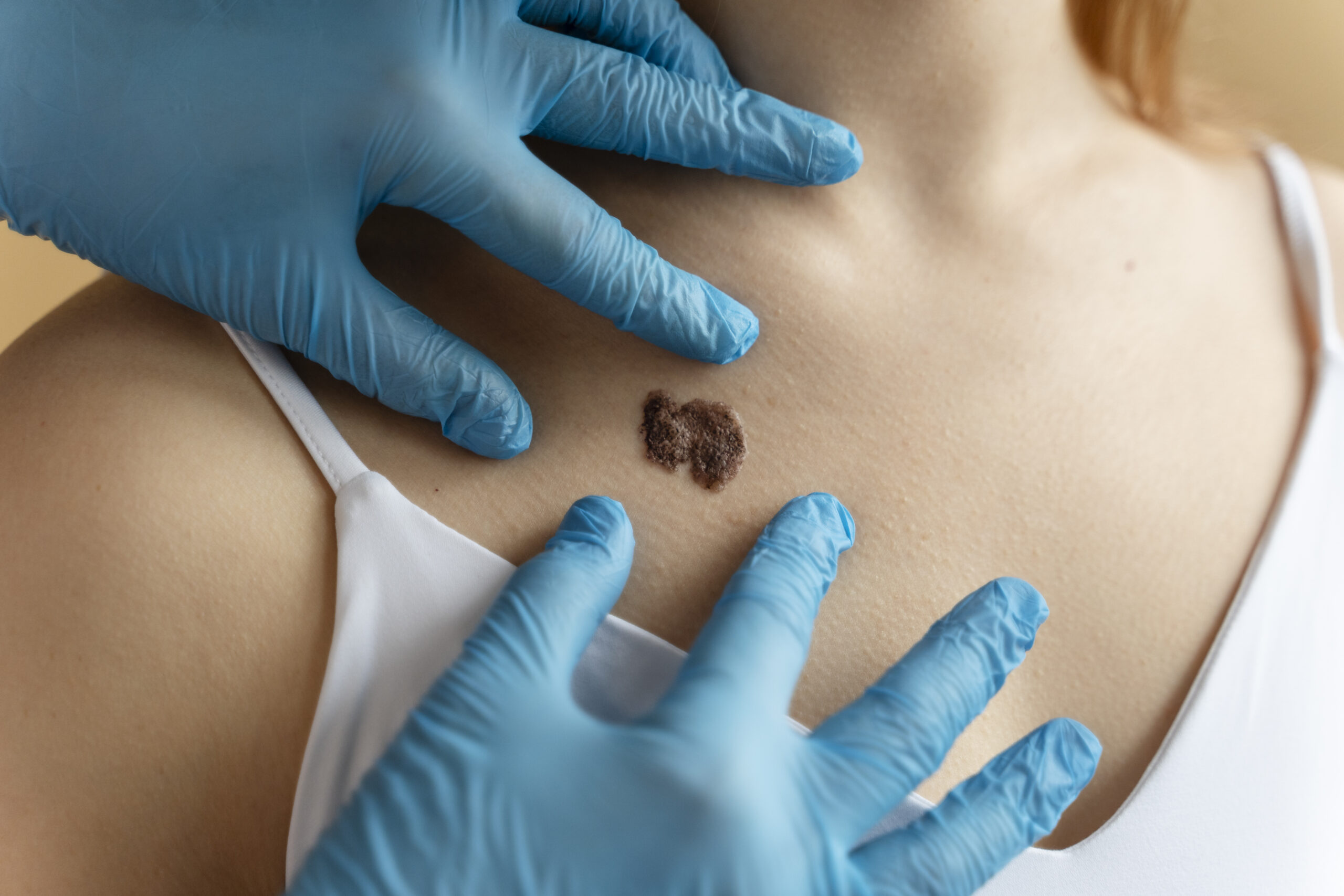 skin tag removal