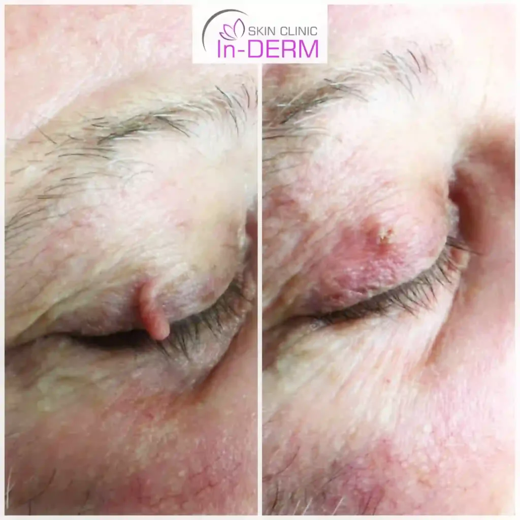 Skin Tag removal Before & After