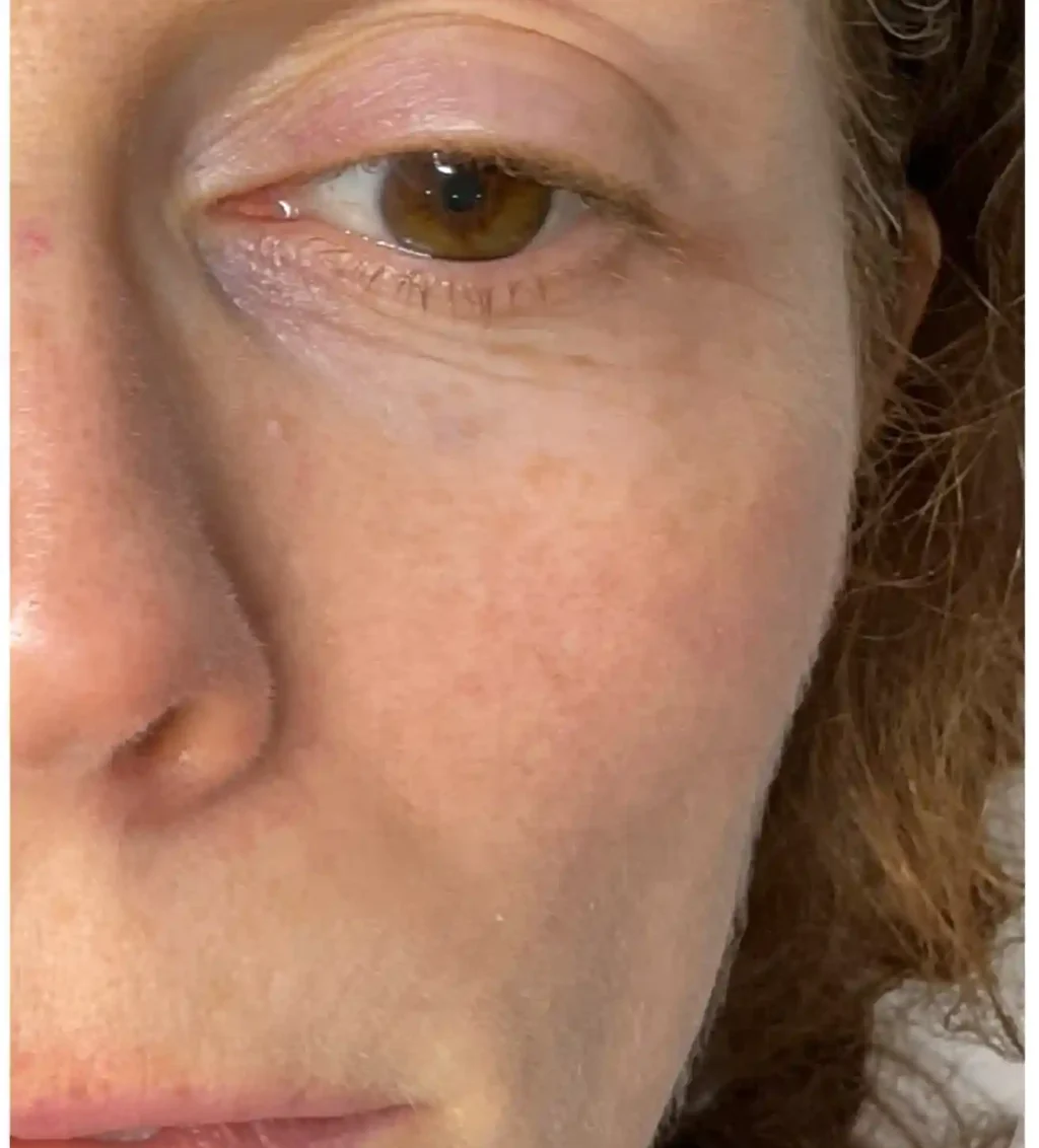 After Facial treatment