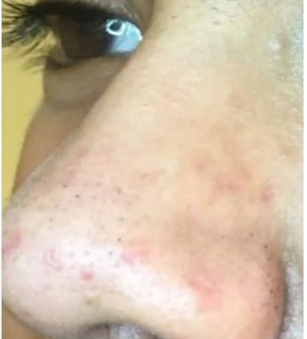 face after acne removal